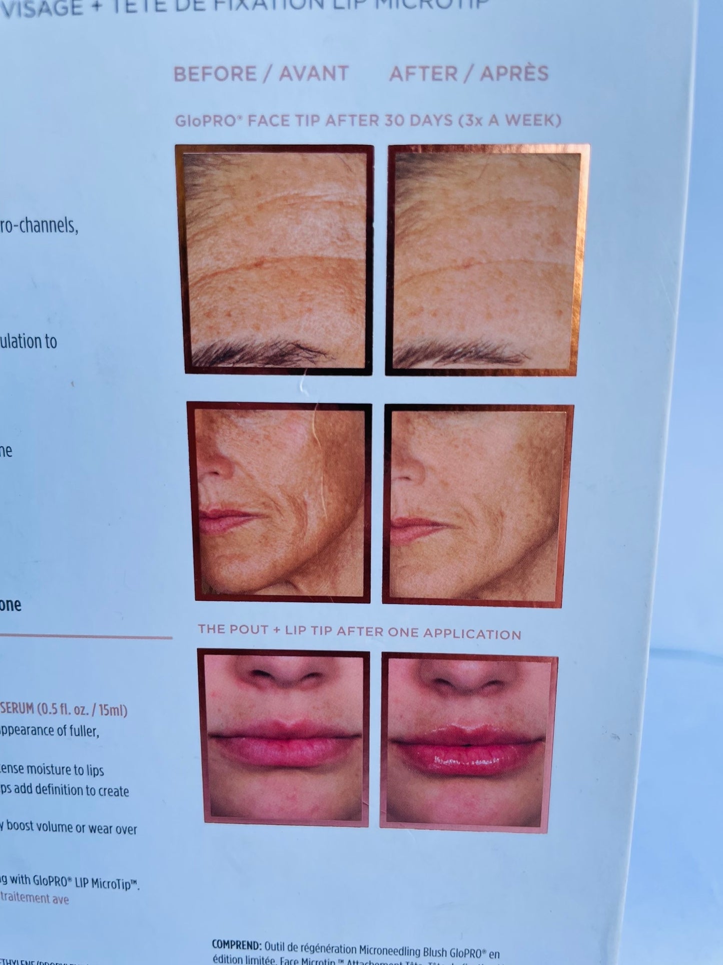 Glopro micro needling regeneration tool