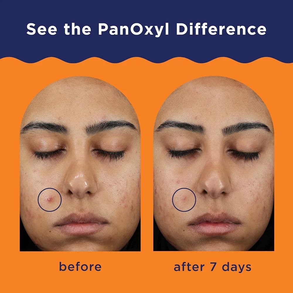 Panoxyl Acne clearing spot treatment (28g)