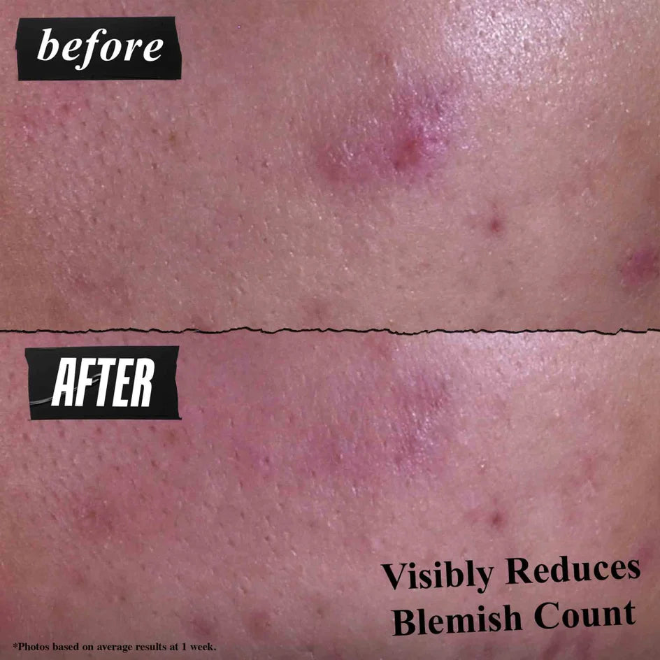 Kiehl's acne treatment