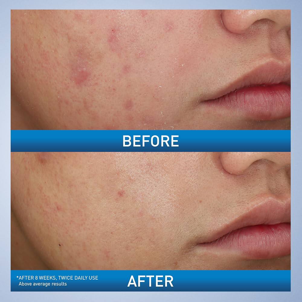 Cerave Foaming Acne Face and Body Wash
