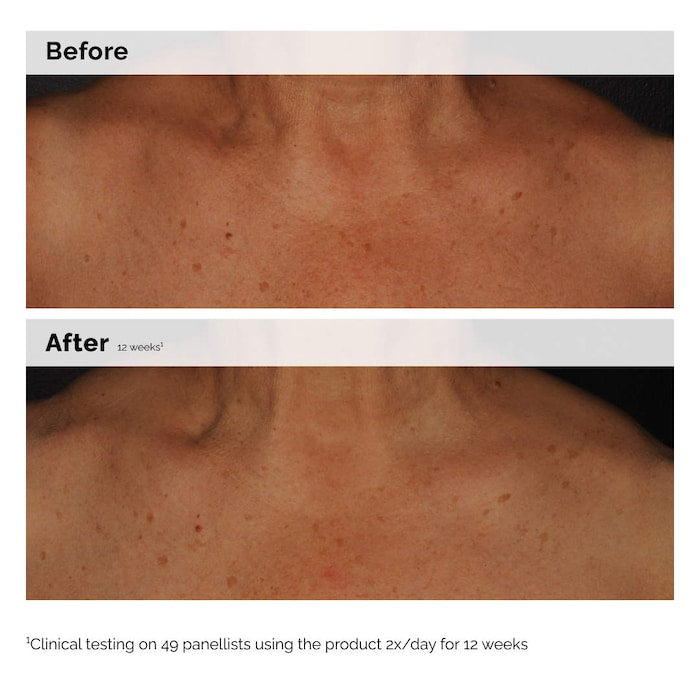 The ordinary Niacinamide 5% Face and Body Emulsion for Dark Spots & Uneven Tone