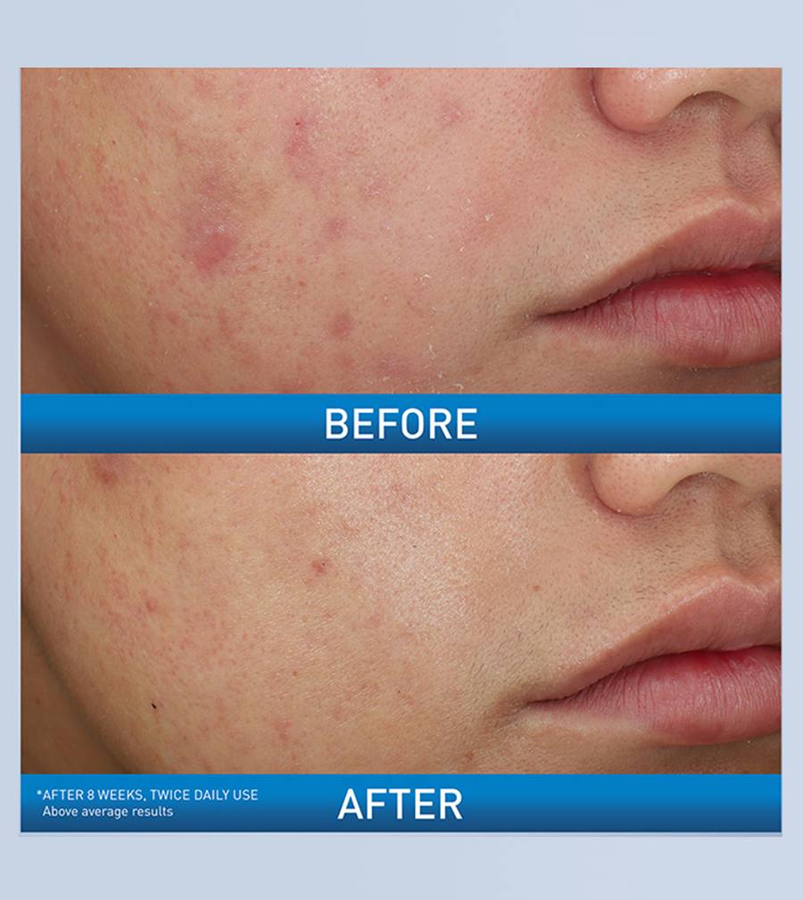 CeraVe Acne Foaming Cream Wash