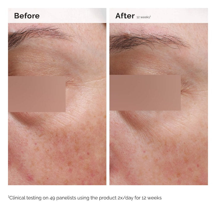 The ordinary Niacinamide 5% Face and Body Emulsion for Dark Spots & Uneven Tone